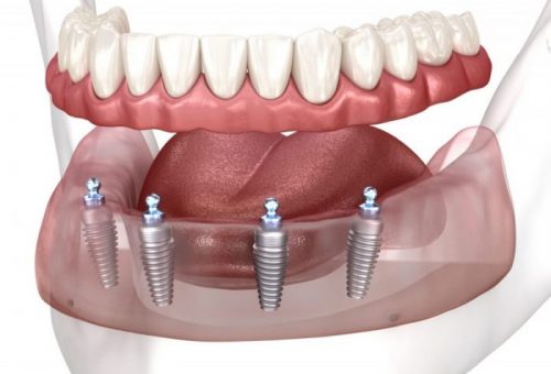 implant-supported dentures supported by four implants