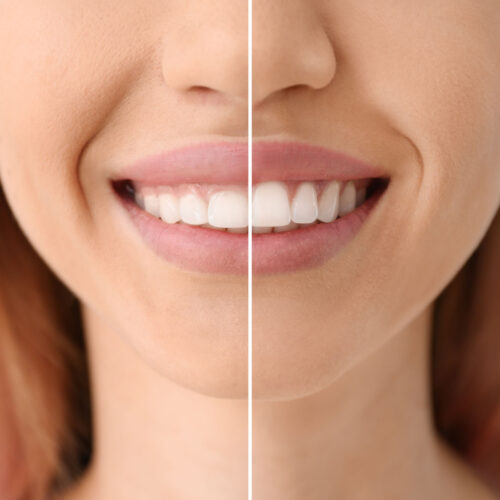 gum contouring before and after